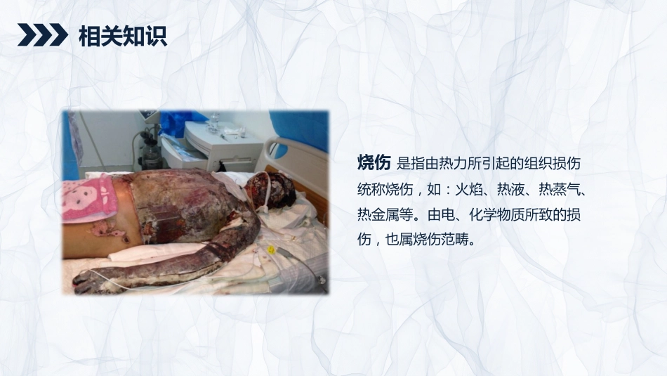 烧伤患者护理查房_第4页