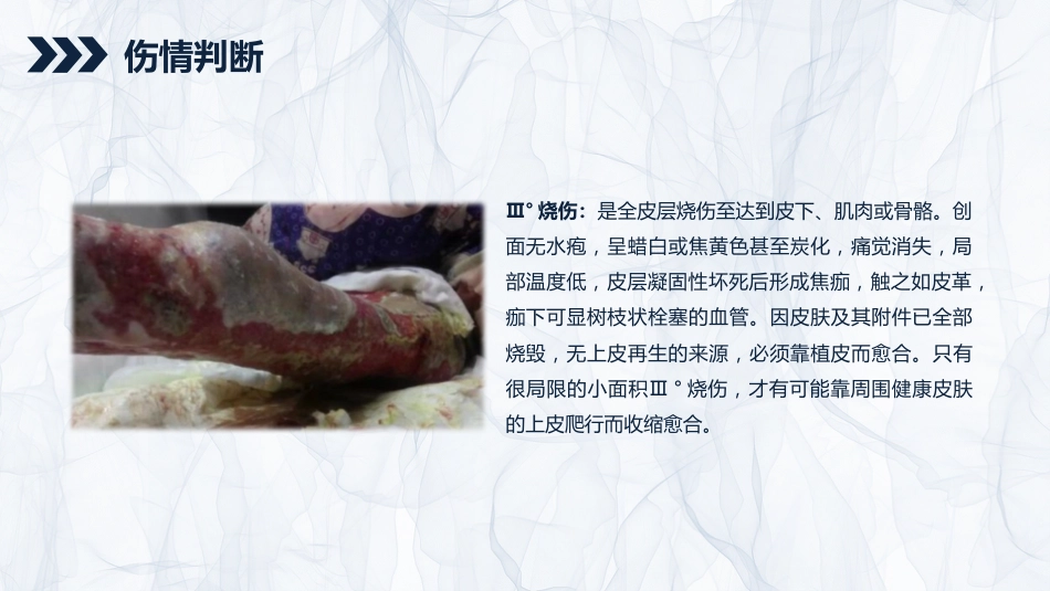 烧伤患者护理查房_第8页