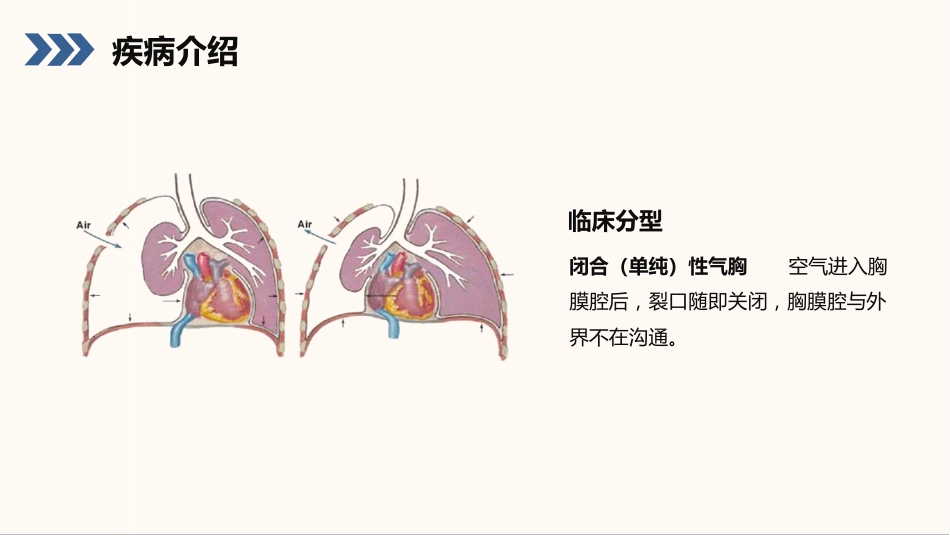 结核性胸膜炎患者护理查房_第7页