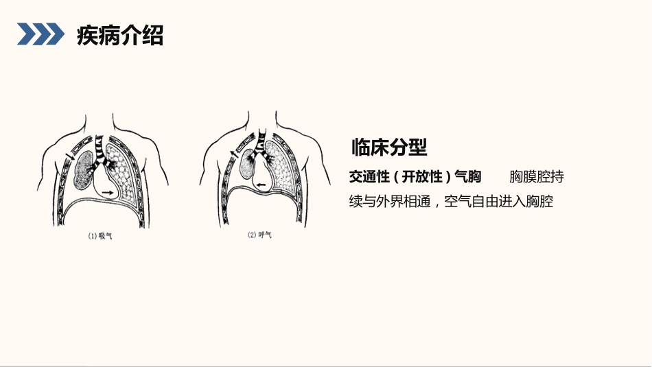 结核性胸膜炎患者护理查房_第8页