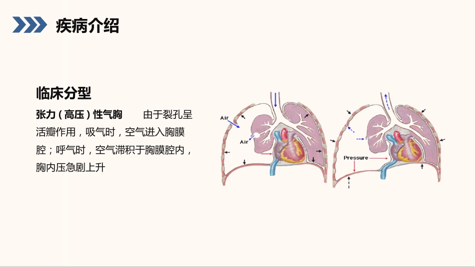 结核性胸膜炎患者护理查房_第9页
