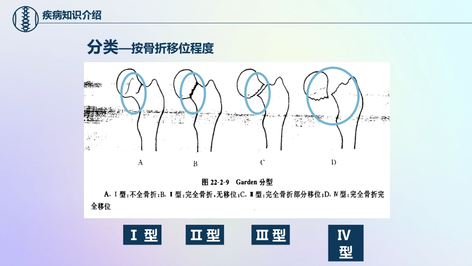 股骨颈骨折护理查房_第15页