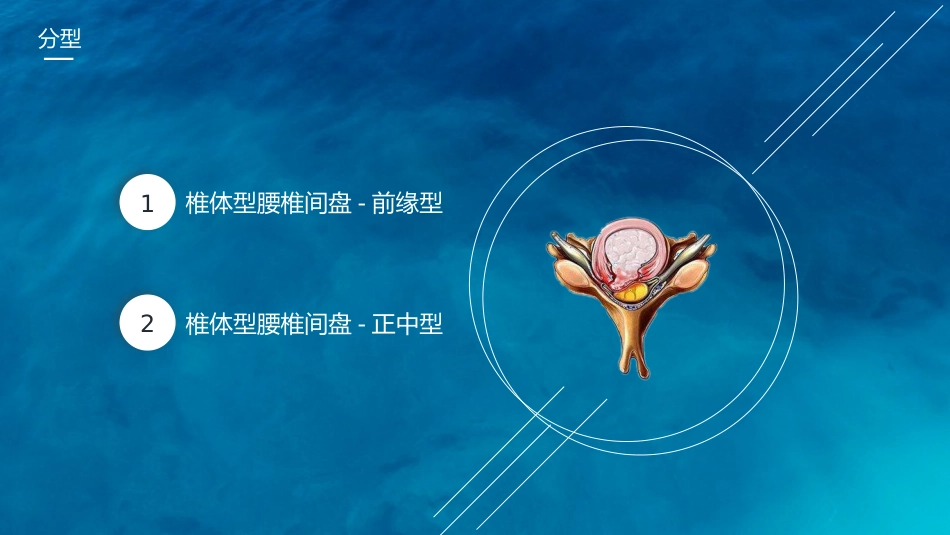 腰椎间盘突出护理查房_第6页