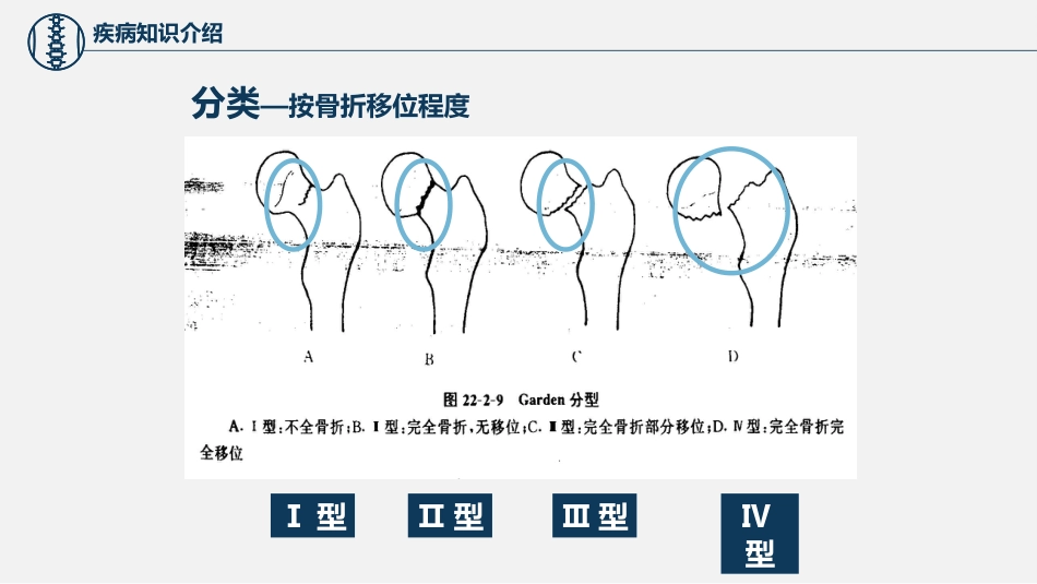 股骨颈骨折护理查房 (2)_第15页
