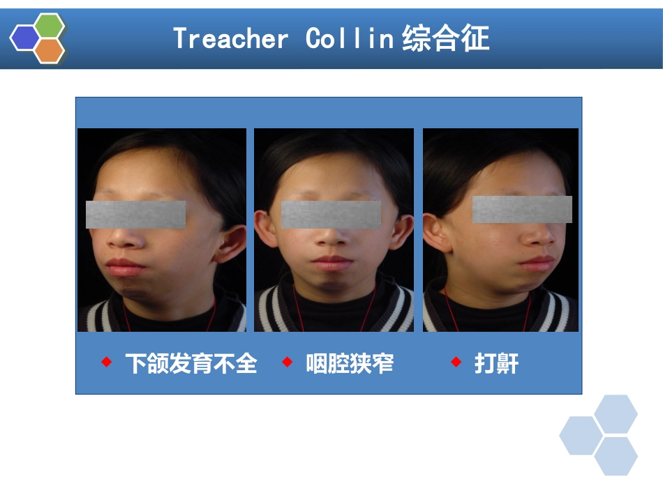 第22章 口腔颌面外科病人的麻醉_第13页