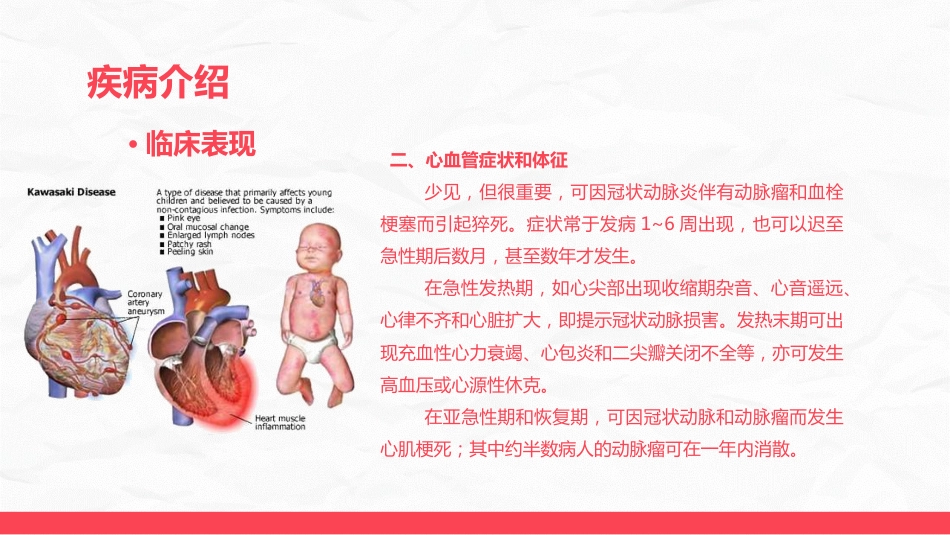 川崎病儿科护理进展_第13页