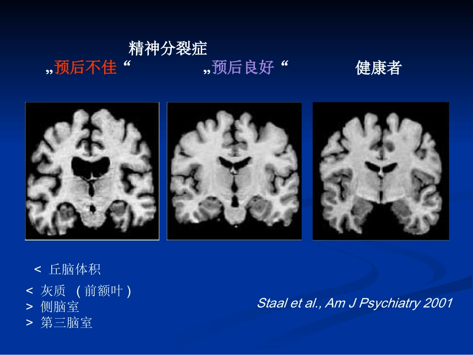 精神分裂症的诊断及治疗_第7页