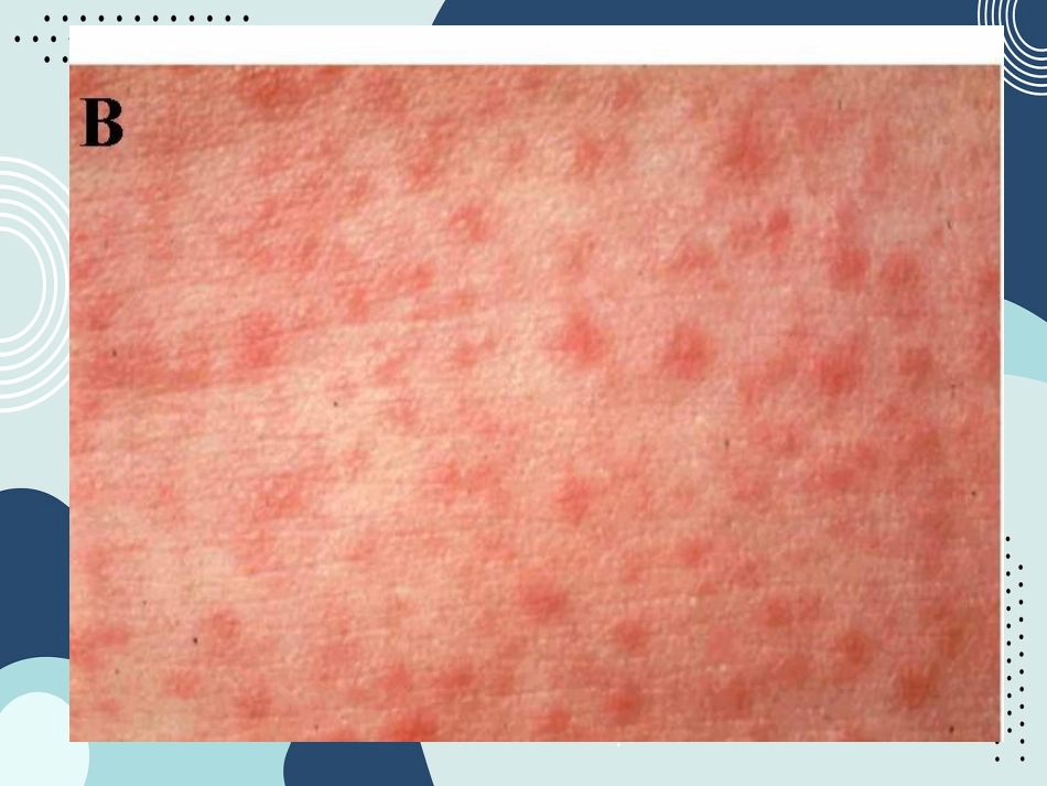 出疹性疾病(麻疹、风疹、幼儿急疹、水痘)--同济_第15页
