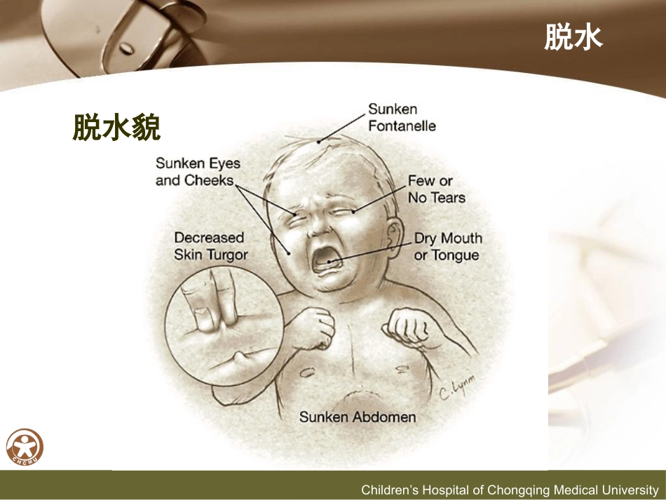 儿传示教 小儿腹泻的诊断和液体疗法_第12页