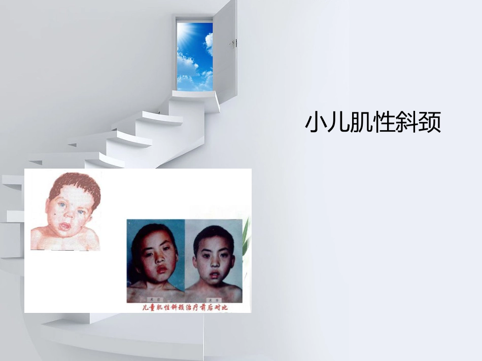 x小儿肌性斜颈_第1页