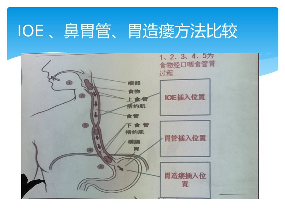 INSURE技术防治早产儿支气管肺发育不良_第11页
