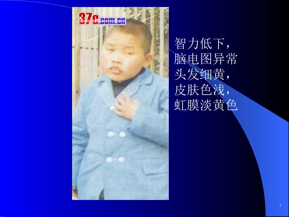 苯丙酮尿症、呆小症_第9页