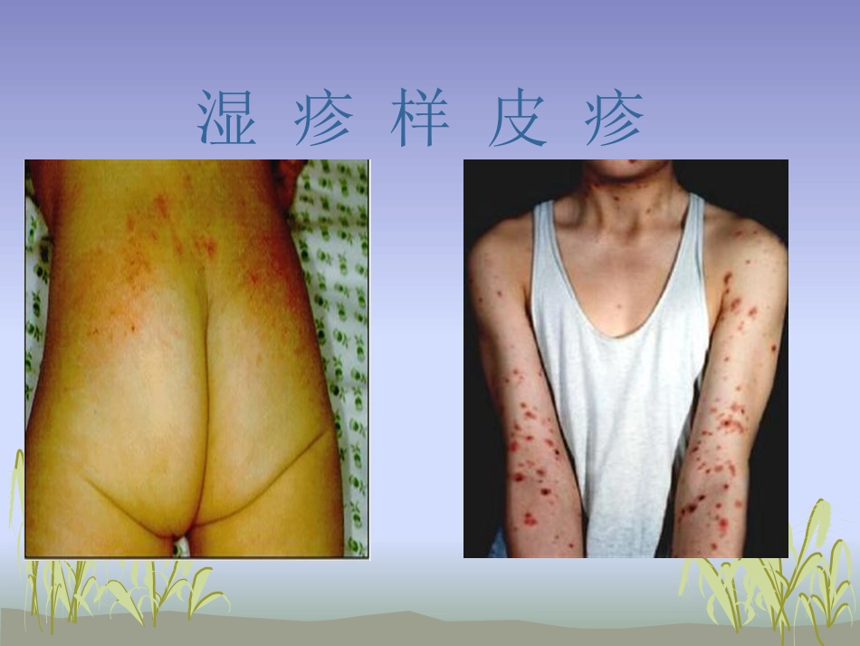 苯丙酮尿症护理_第14页
