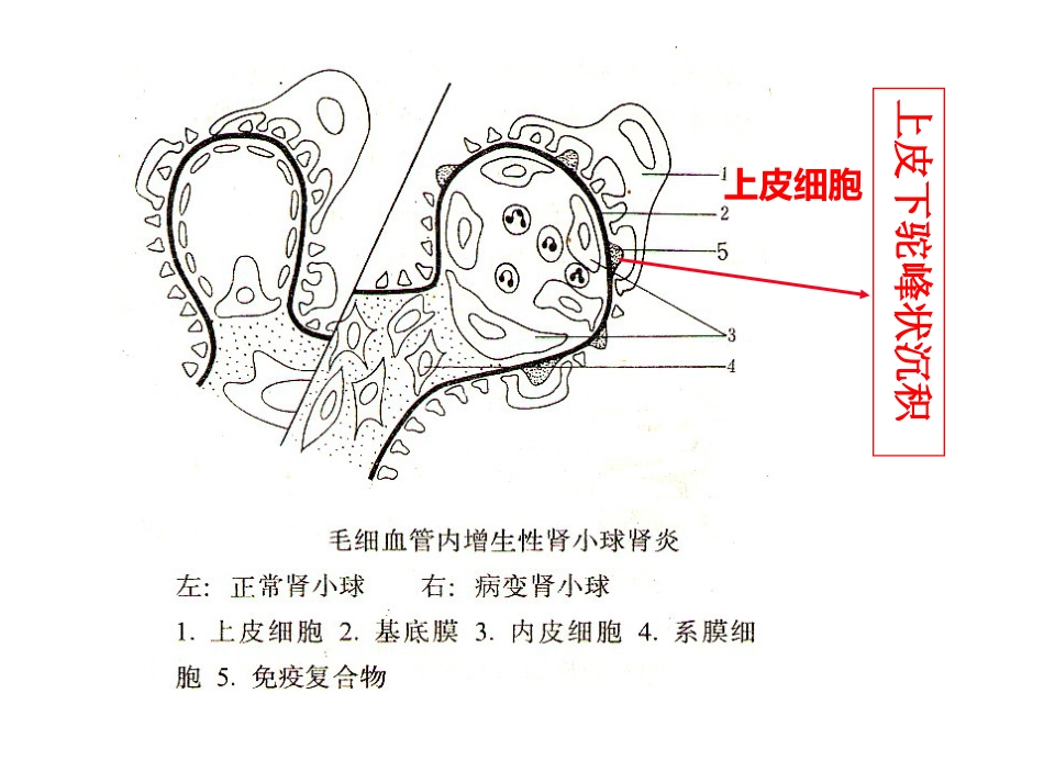【儿科学】急性肾小球肾炎_第11页