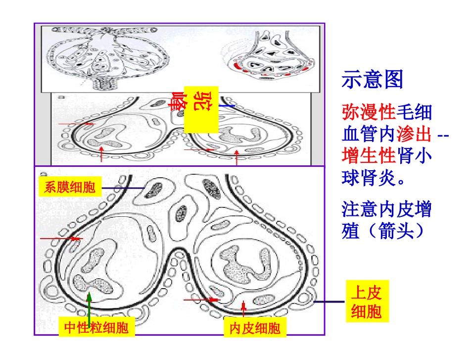 【儿科学】急性肾小球肾炎_第12页