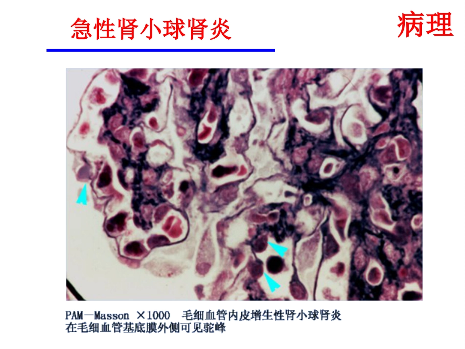【儿科学】急性肾小球肾炎_第13页