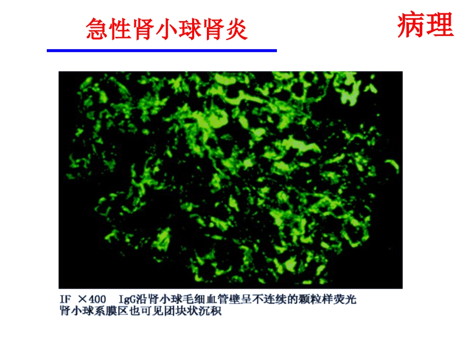 【儿科学】急性肾小球肾炎_第14页