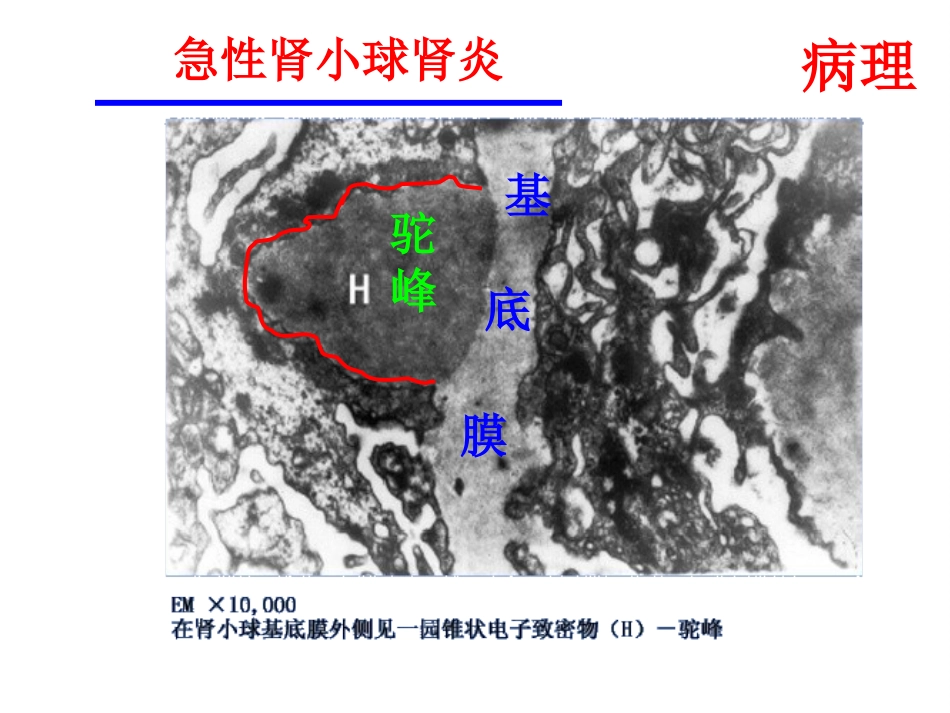 【儿科学】急性肾小球肾炎_第15页
