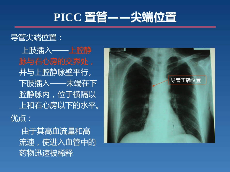 新生儿PICC介绍及维护_第13页