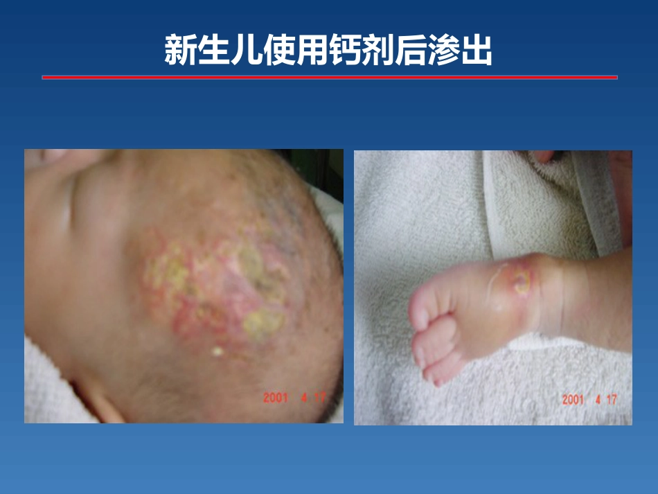 新生儿PICC介绍及维护_第6页