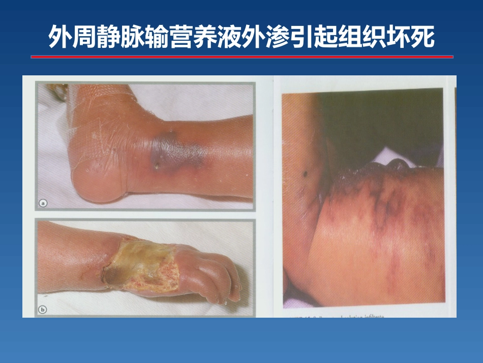 新生儿PICC介绍及维护_第7页