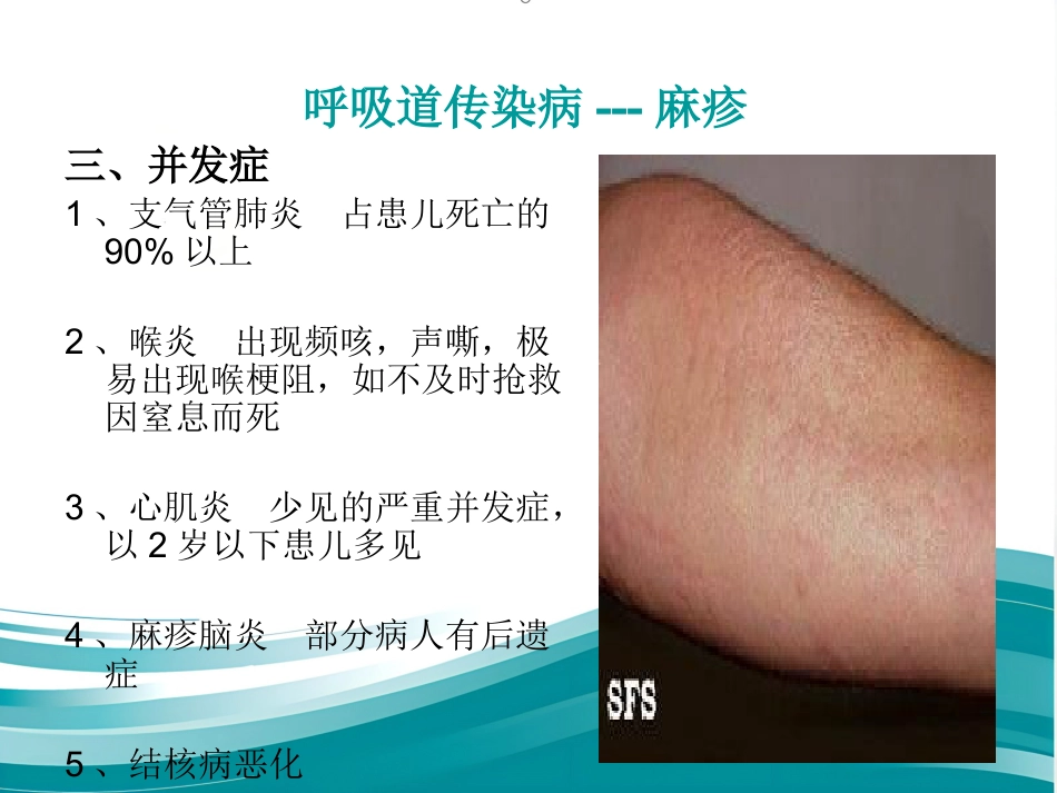 儿科常见传染病及防护_第11页