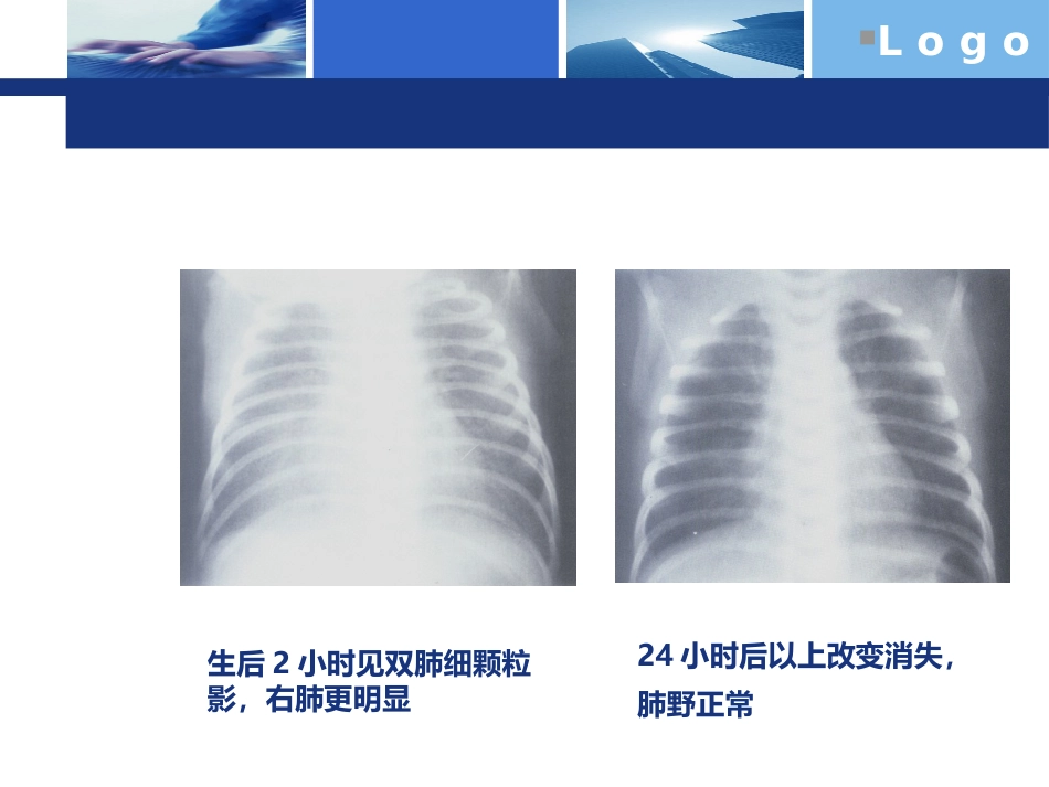 NRDS新生儿呼吸窘迫综合征_第8页