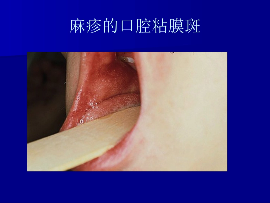 儿科常见传染病的防治_第10页