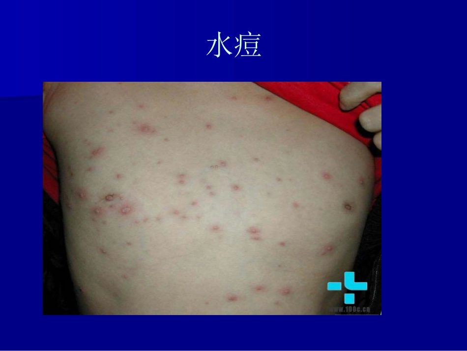 儿科常见传染病的防治_第13页