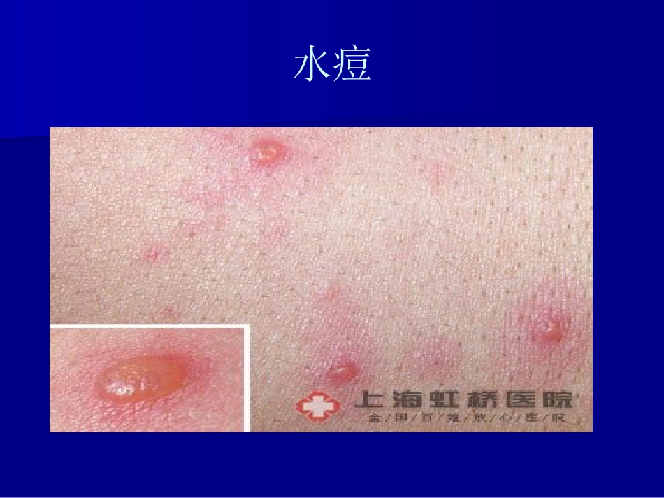 儿科常见传染病的防治_第14页