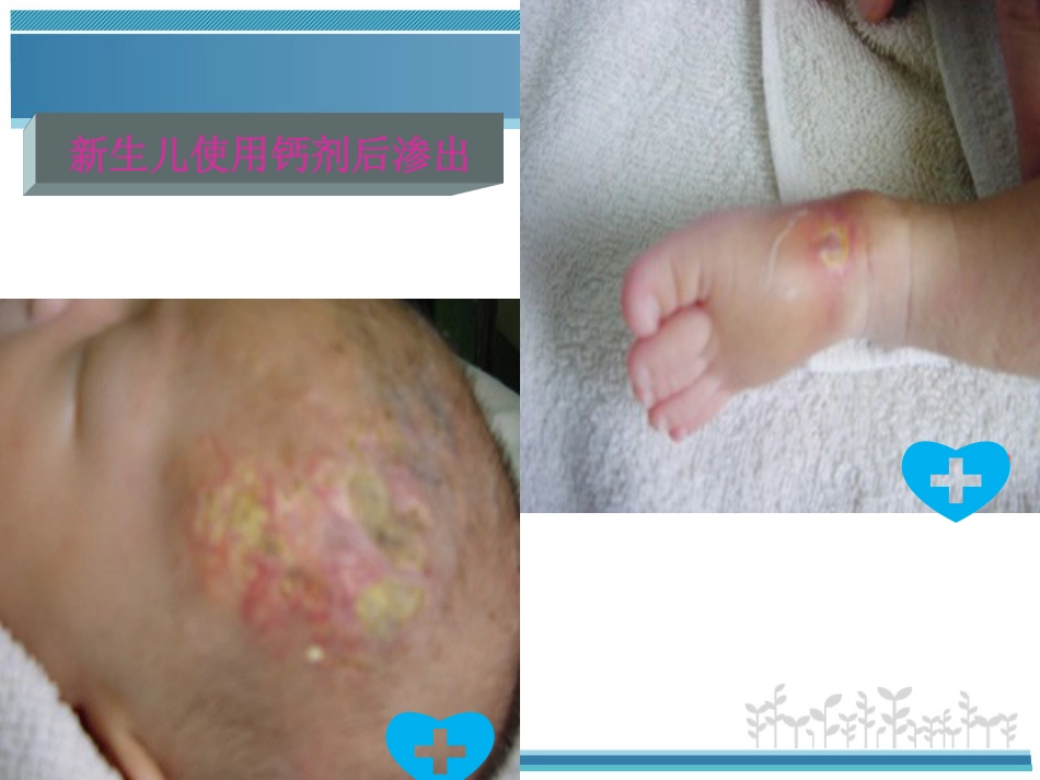 新生儿PICC使用及护理维护-PPT_第6页