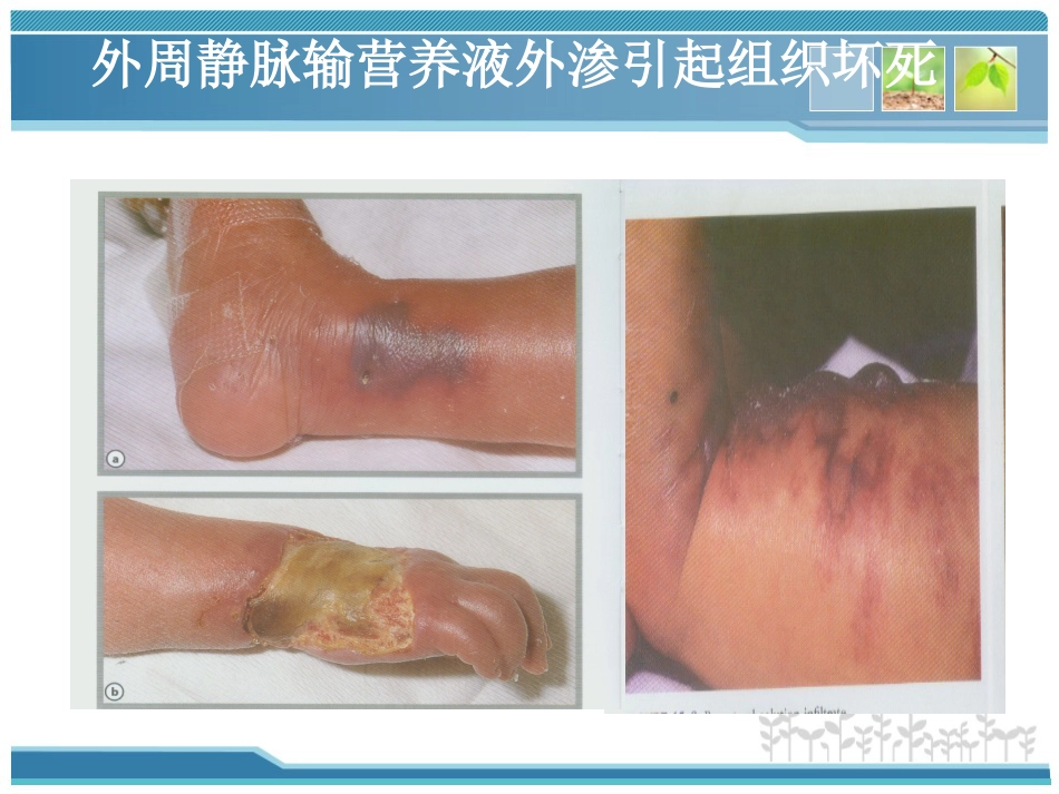 新生儿PICC使用及护理维护-PPT_第7页