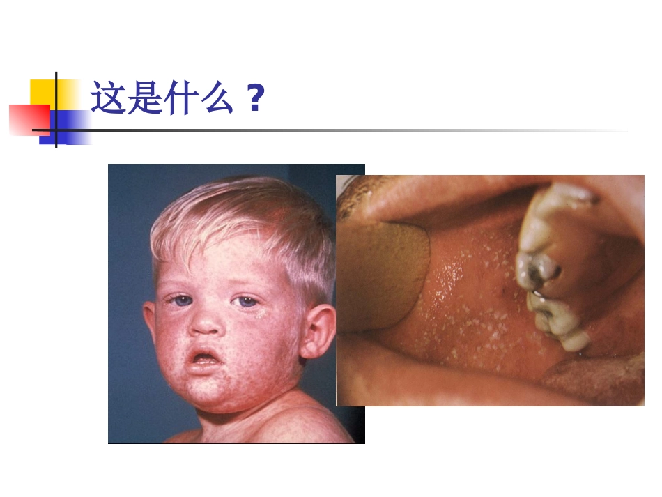儿科病案讨论(麻疹)_第10页
