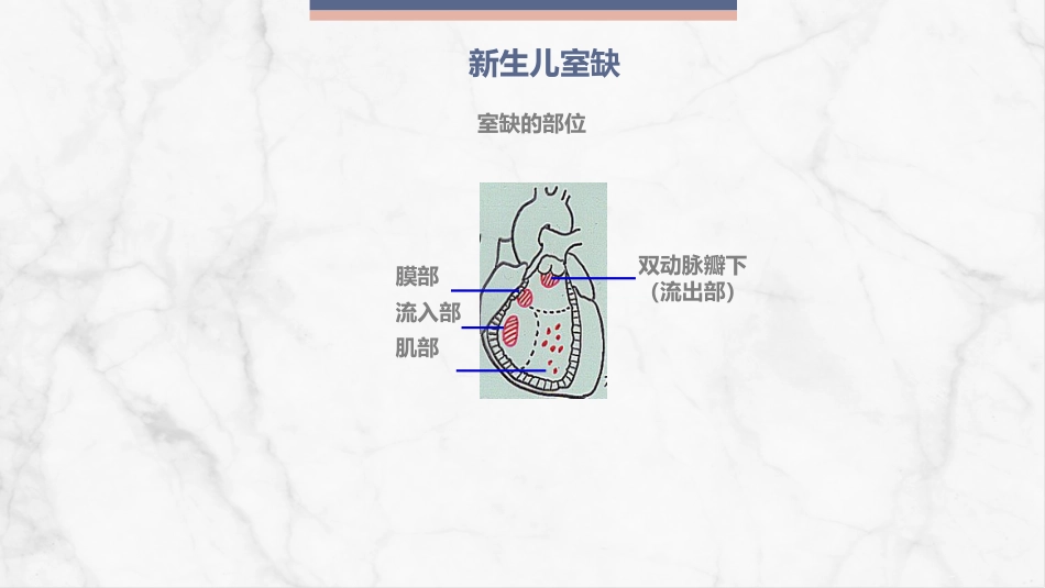 新生儿先天性心脏病病例讨论_第6页