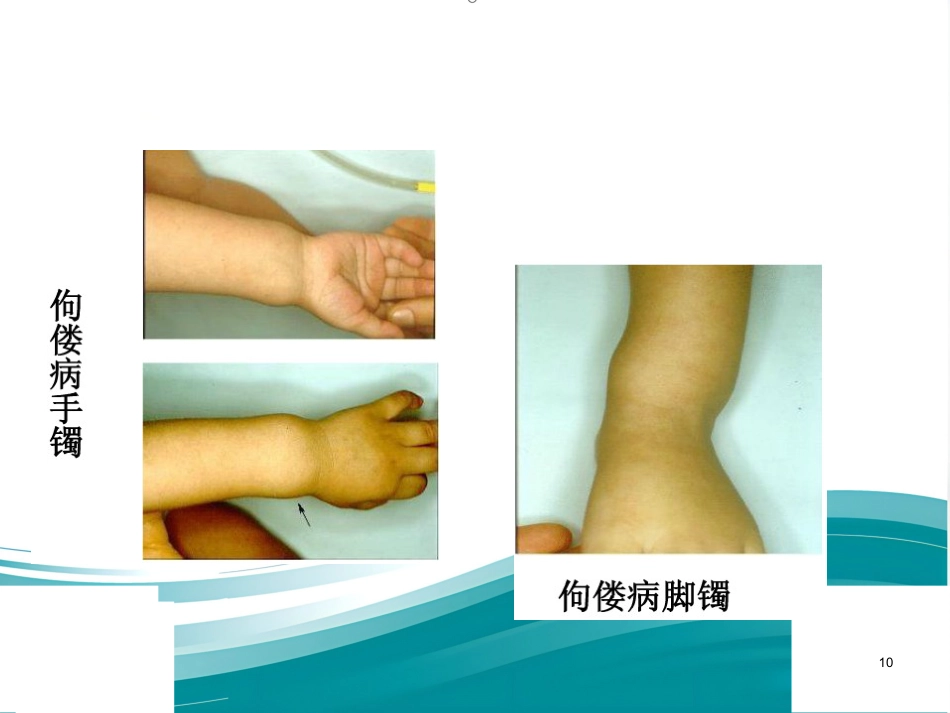 低磷性佝偻病ppt课件_第10页