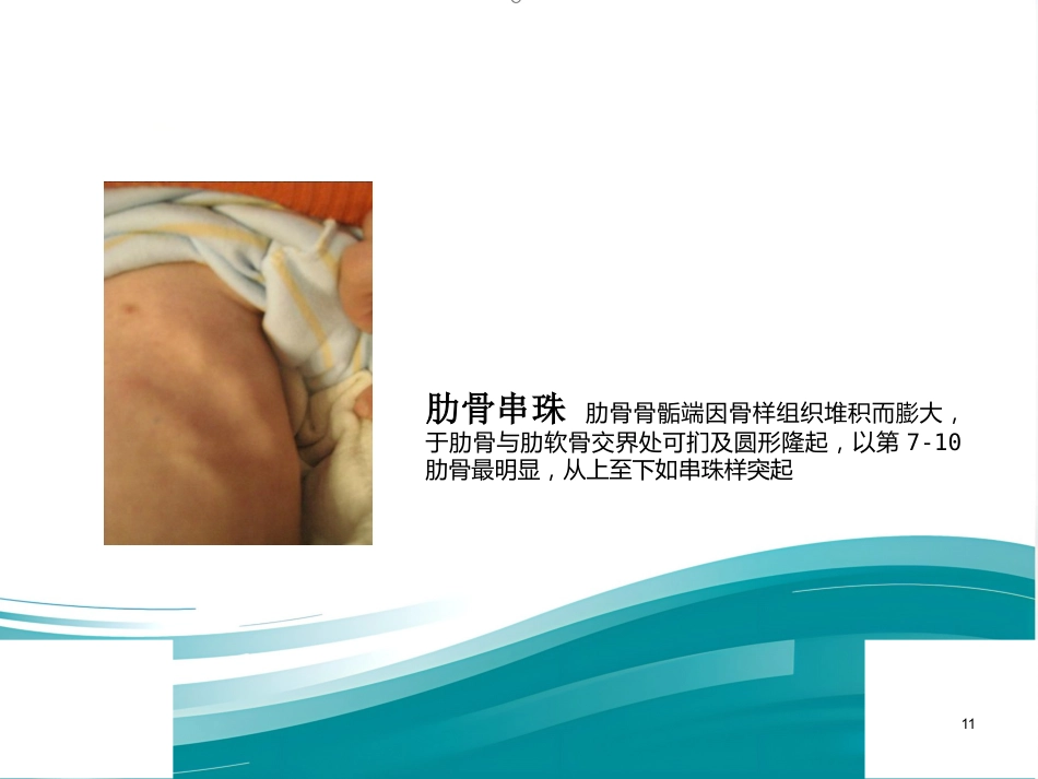 低磷性佝偻病ppt课件_第11页