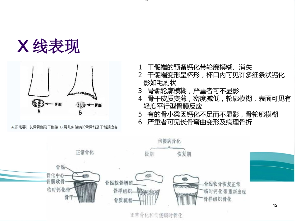 低磷性佝偻病ppt课件_第12页