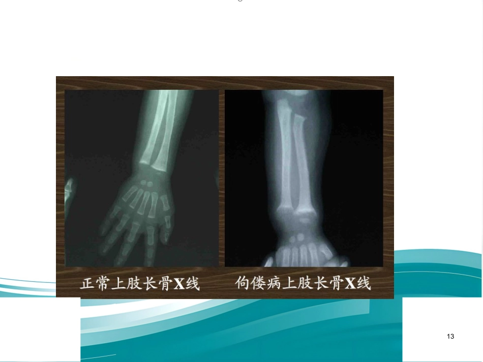 低磷性佝偻病ppt课件_第13页