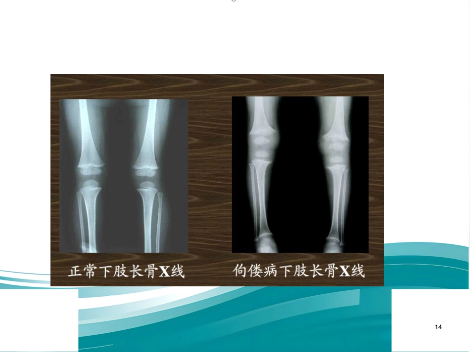 低磷性佝偻病ppt课件_第14页