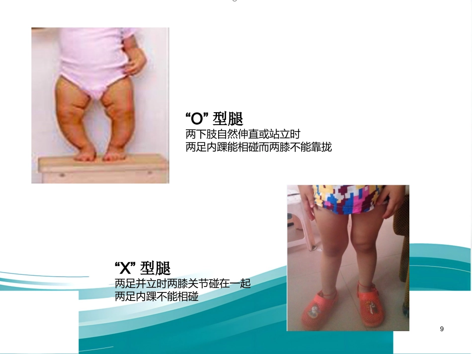 低磷性佝偻病ppt课件_第9页