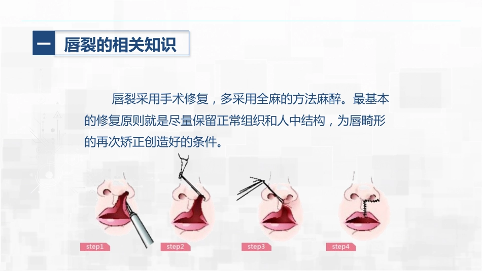 新生儿唇裂的护理+问题_第11页