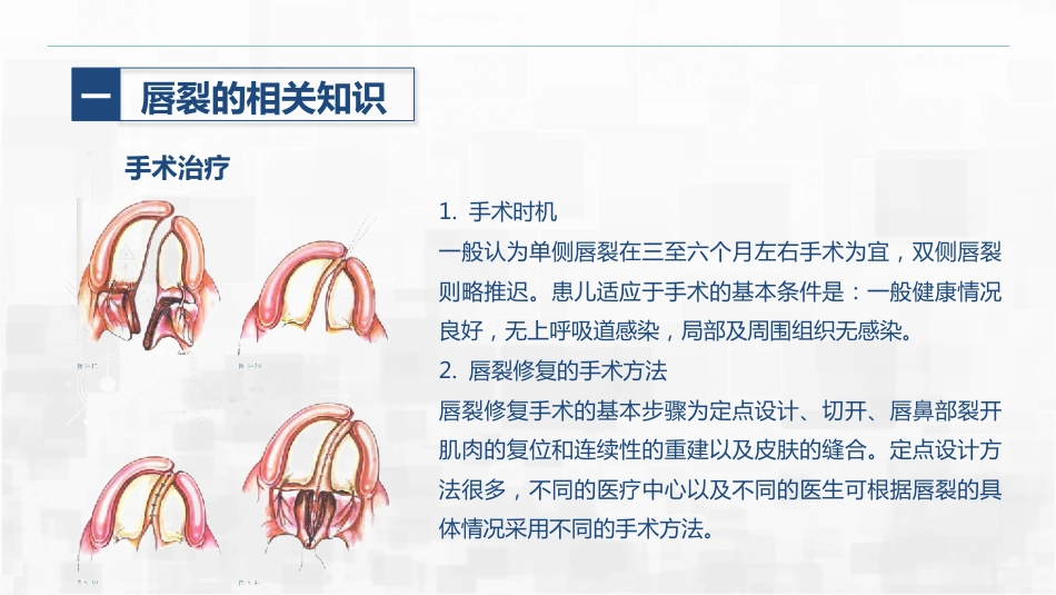 新生儿唇裂的护理+问题_第12页