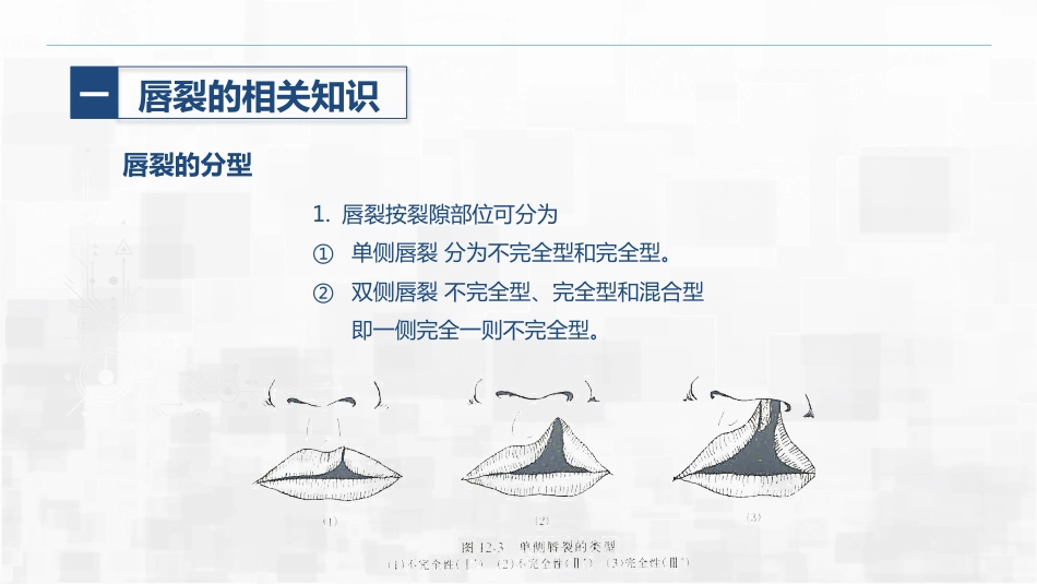 新生儿唇裂的护理+问题_第8页