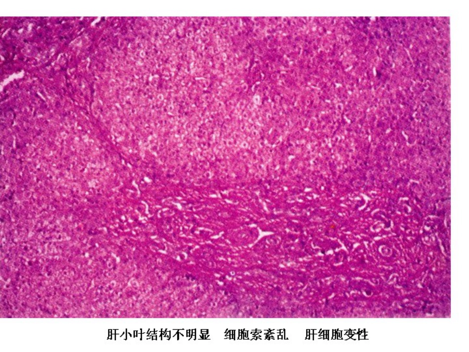 胆道闭锁儿科讲课课件课件_第12页