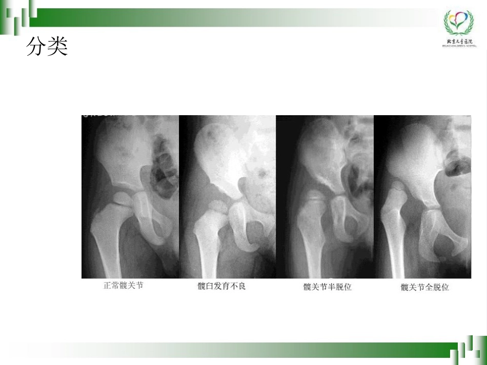 0-6岁儿童肢体残疾筛查技术(孙琳)_第5页
