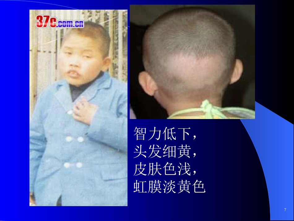 苯丙酮尿症 (2)_第8页