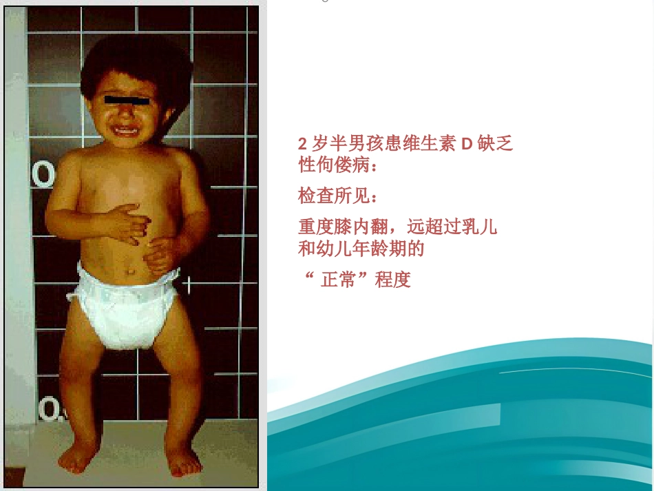 2016版佝偻病全球共识_第5页