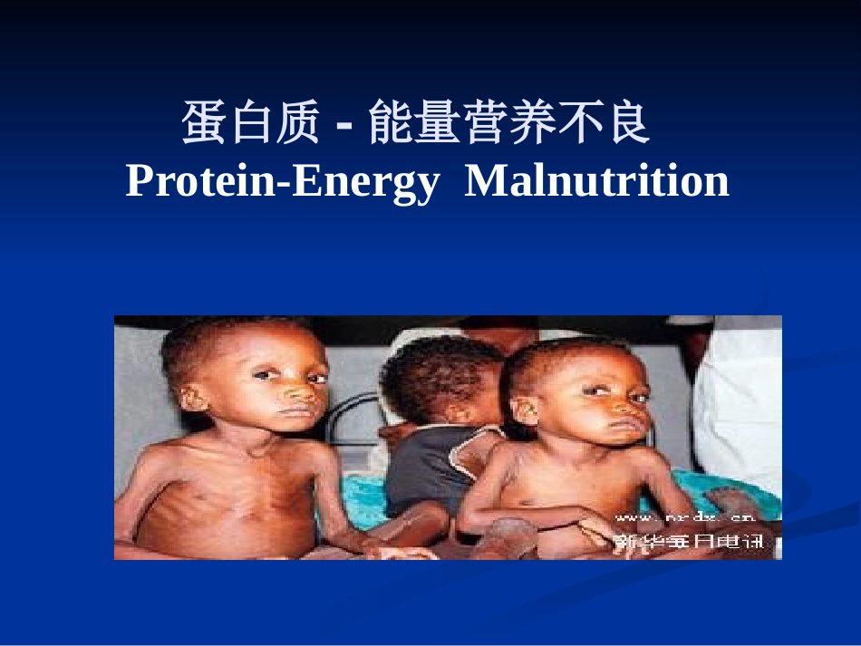 儿科蛋白质-能量营养不良 PEM_第1页