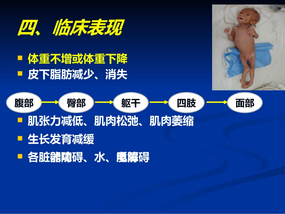 儿科蛋白质-能量营养不良 PEM_第15页