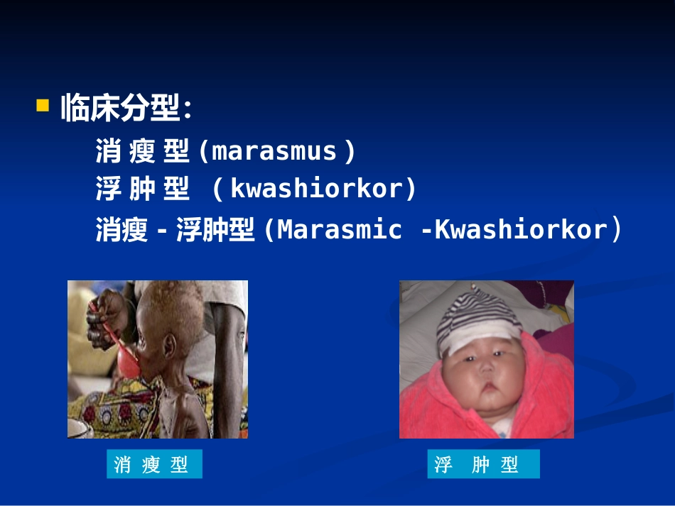 儿科蛋白质-能量营养不良 PEM_第6页
